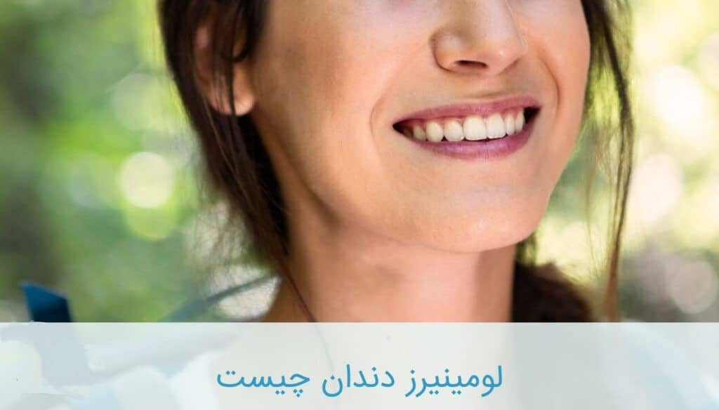 لومینرز دندان