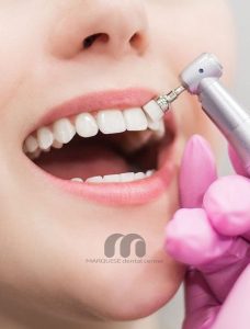 جرمگیری و بلیچینگ دندان برای لبخند زیباتر