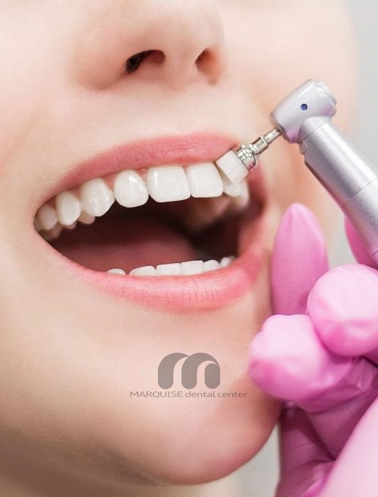 جرمگیری و بلیچینگ دندان برای لبخند زیباتر