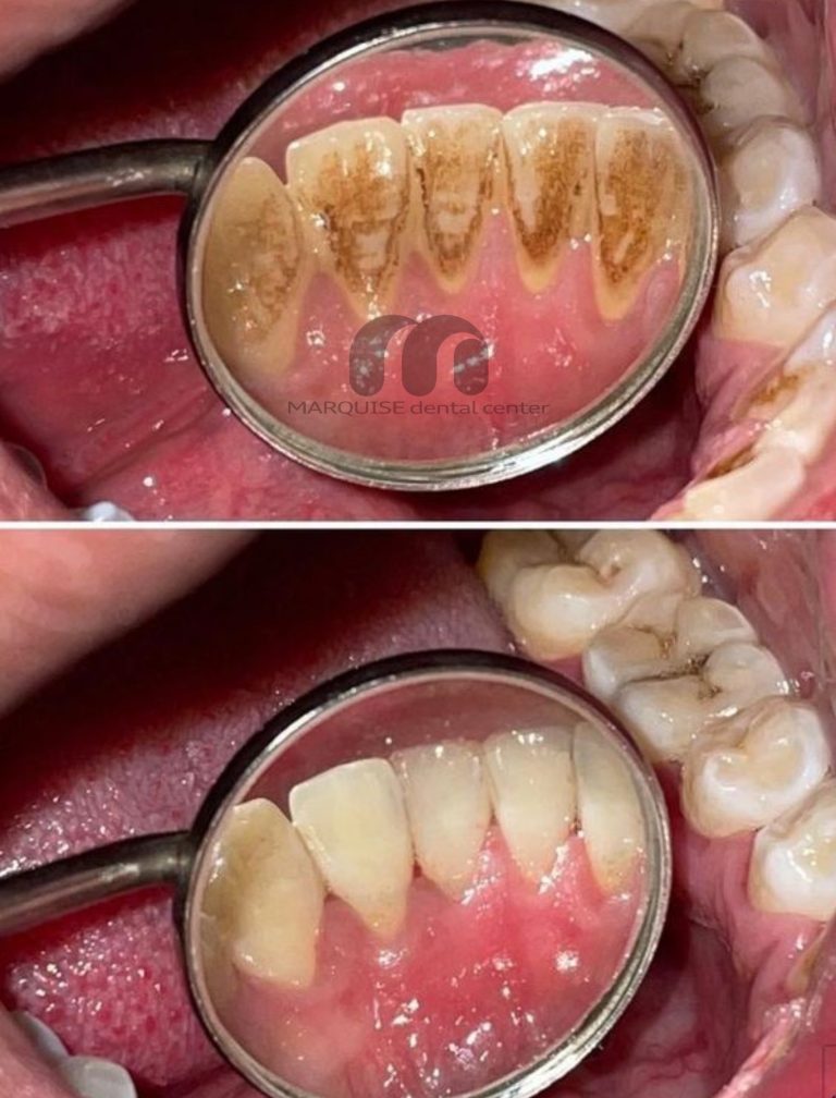 جرمگیری دندان در کلینیک دندانپزشکی مارکیز