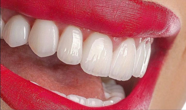 لمینیت سرامیکی با کیفیت روی دندان فک بالا در کلینیک دندانپزشکی مارکیز تهران