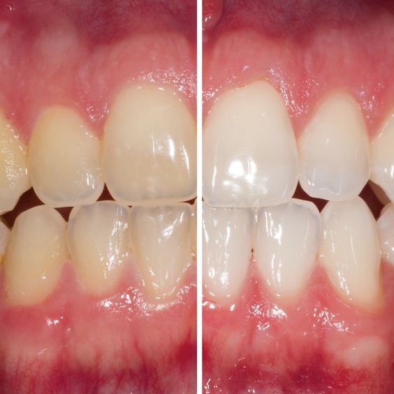 نتیجه بلیچینگ دندان فک بالا و پایین در کلینیک دندانپزشکی مارکیز پونک