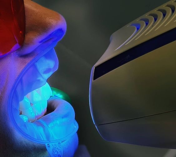 وش حرفه‌ای بلیچینگ دندان با تکنولوژی روز در کلینیک دندانپزشکی مارکیز