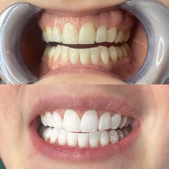 دندان‌های طبیعی قبل و بعد از انجام بلیچینگ در کلینیک دندانپزشکی مارکیز پونک