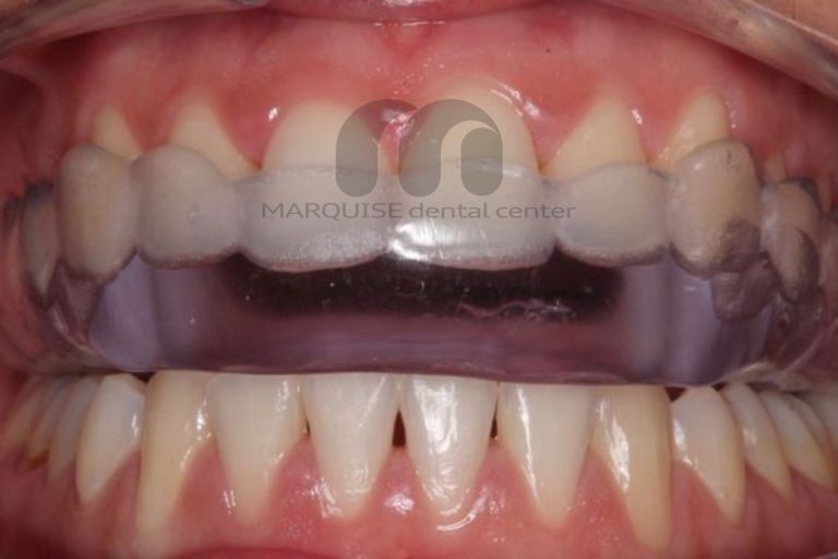 استفاده از نایت‌گارد برای درمان دندان‌قروچه شبانه