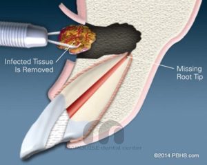 درمان عفونت انتهای ریشه دندان در غرب تهران