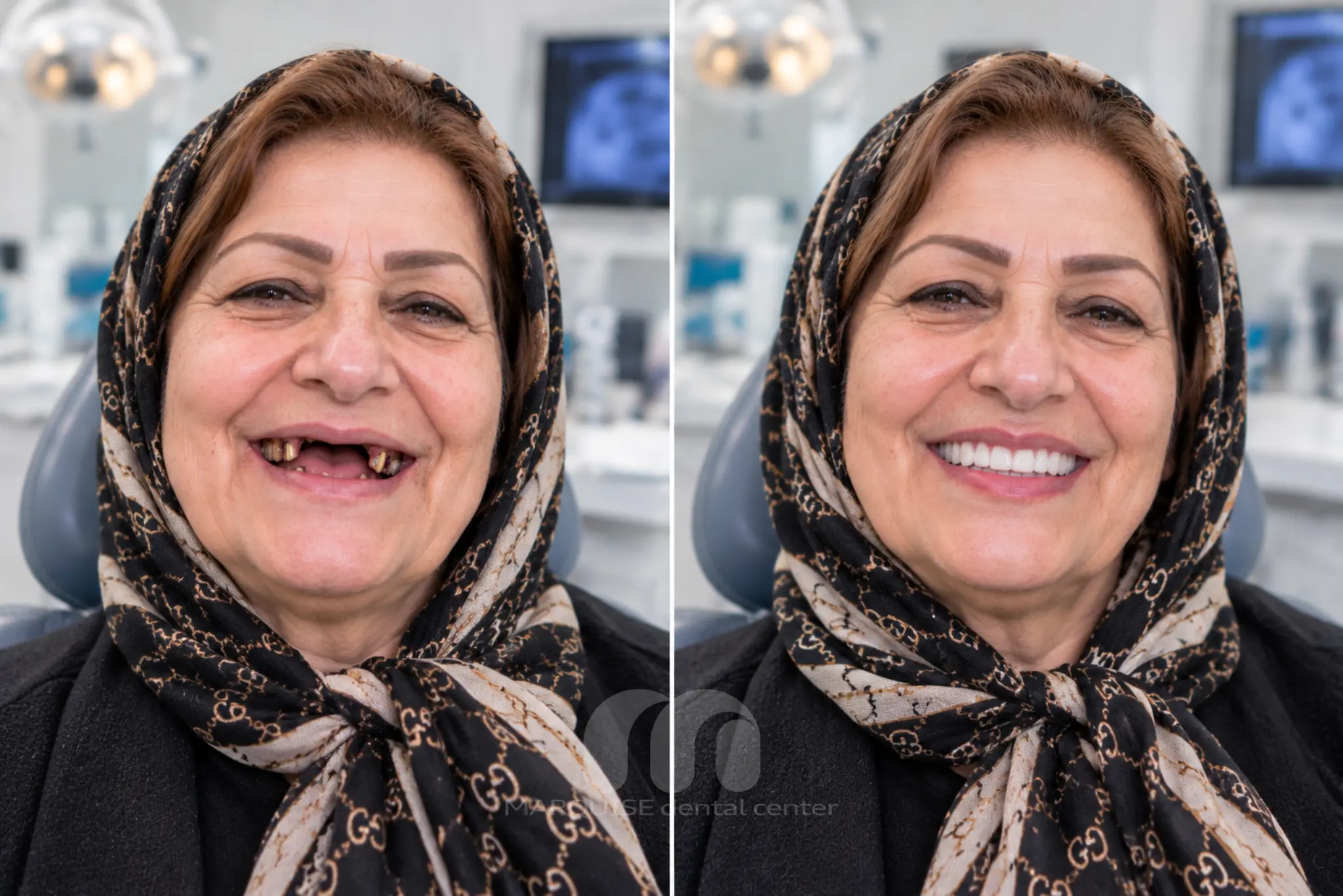 تصویر شبیهسازیشده قبل و بعد ایمپلنت دندانهای جلو