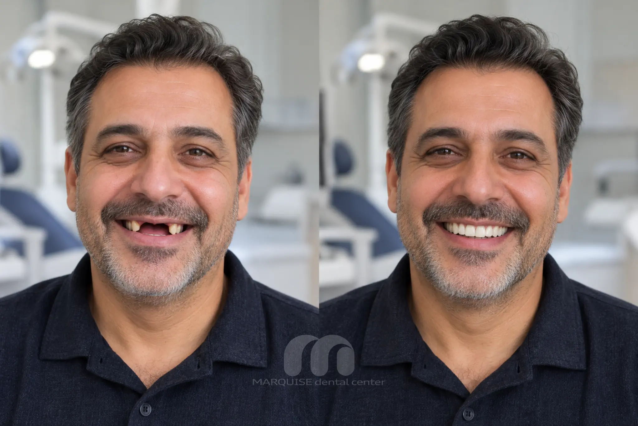تصویر شبیهسازیشده قبل و بعد بازسازی کامل دندانها با ایمپلنت