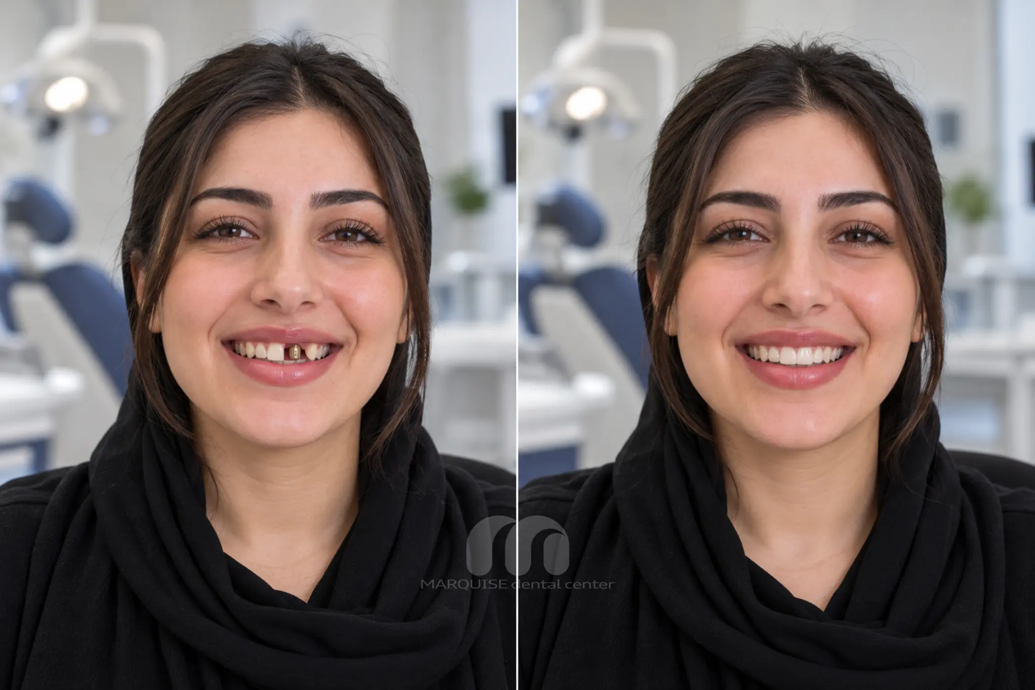 تصویر شبیهسازیشده قبل و بعد ایمپلنت دندان آسیاب
