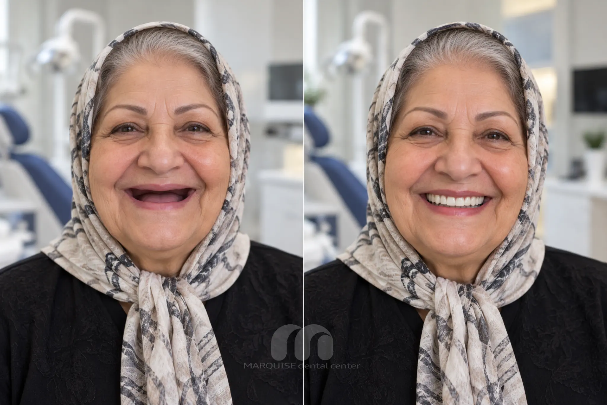 تصویر شبیهسازیشده قبل و بعد ایمپلنت با ظاهر طبیعی