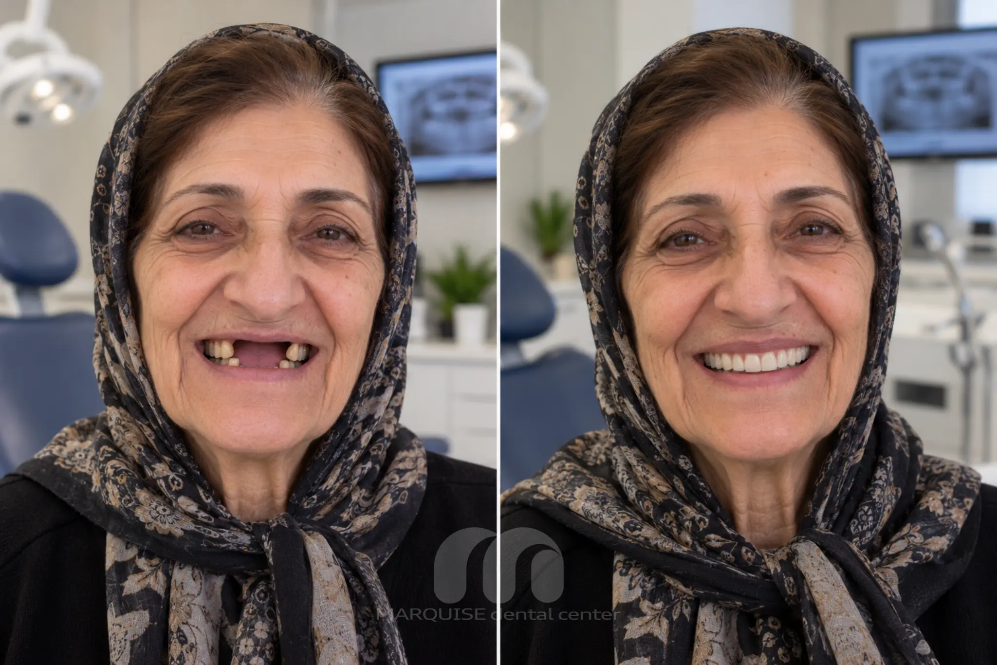 تصویر شبیهسازیشده قبل و بعد بازسازی لبخند با ایمپلنت