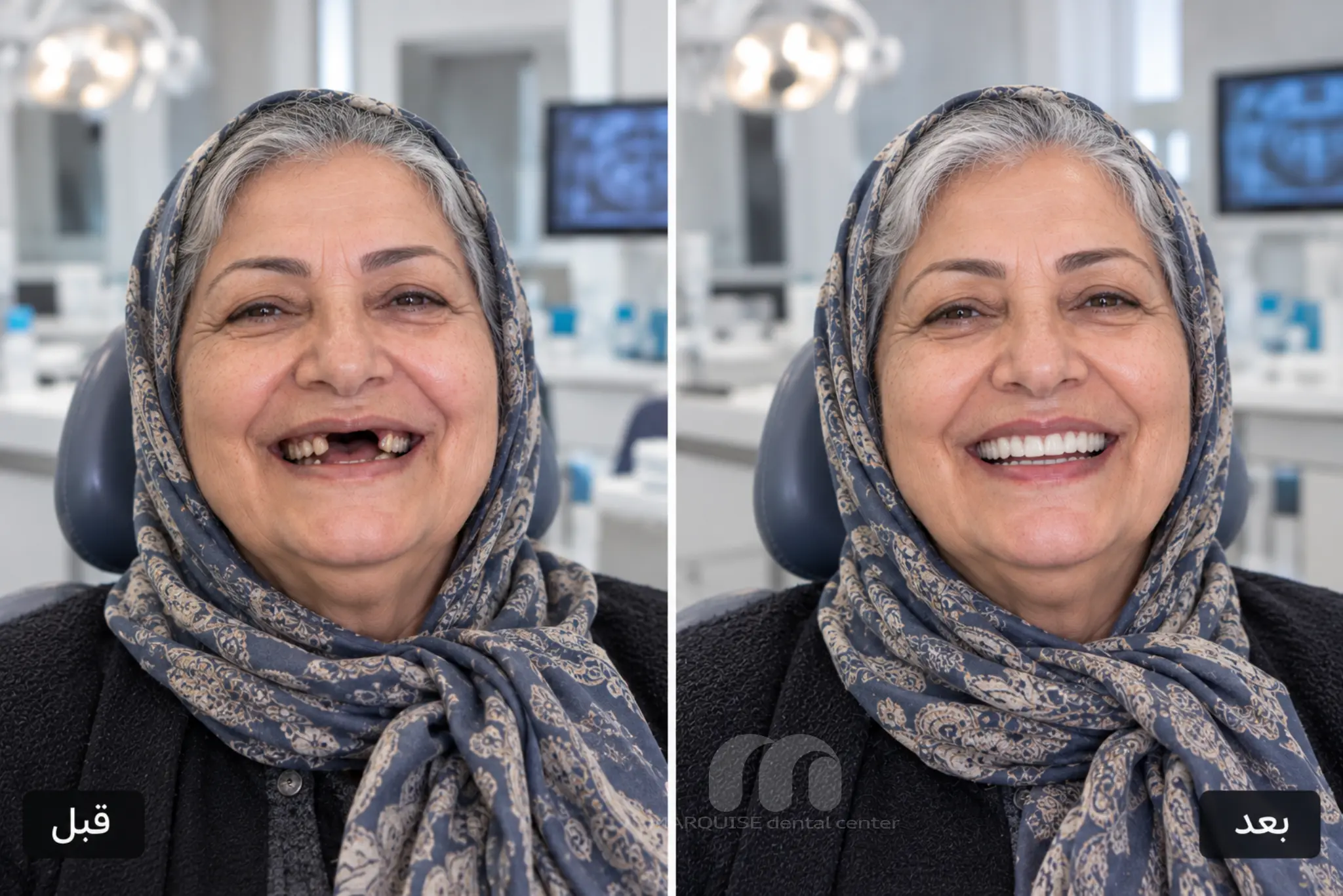 تصویر شبیهسازیشده قبل و بعد ایمپلنت فک بالا