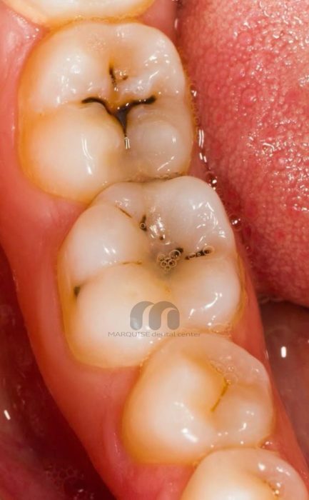 دندان عفونتی با التهاب و درد