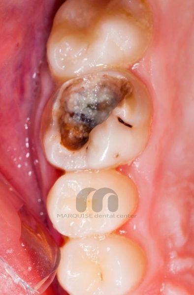 پوسیدگی عمیق دندان و تخریب ساختار داخلی