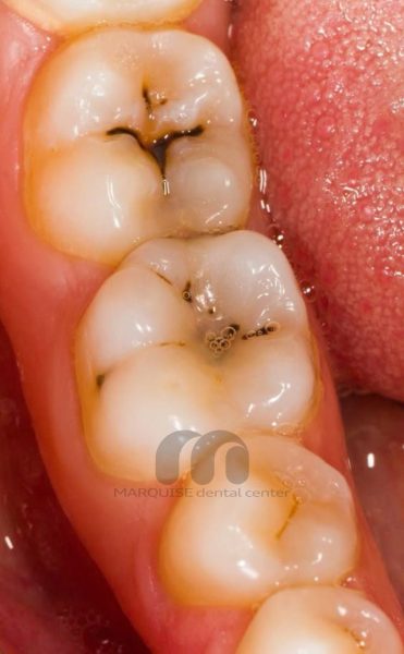 پوسیدگی سطحی دندان در مراحل اولیه